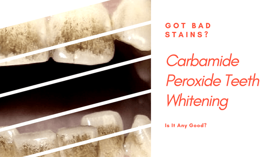 Is Carbamide Peroxide Teeth Whitening Dangerous?