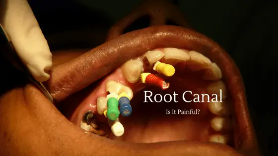 Is getting a root canal painful? – I’m Terrified!