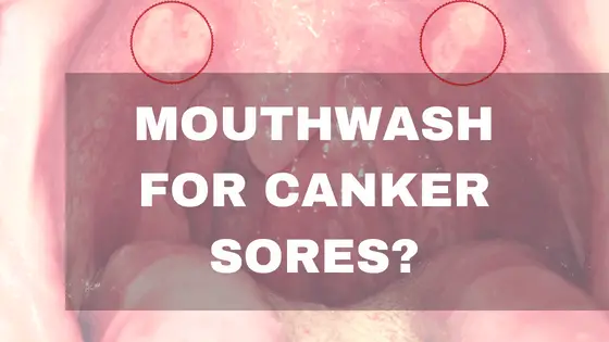 Does Mouthwash Help Canker Sores? Which One To Use…