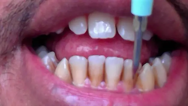 how to remove brown stains on teeth