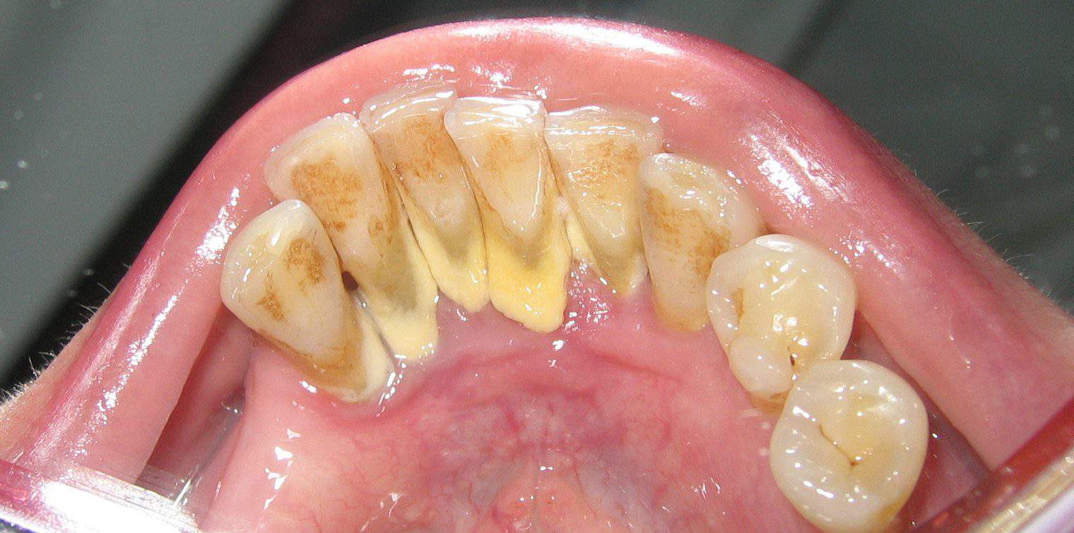 can-a-dentist-remove-tartar-the-risks-involved-teethmastery