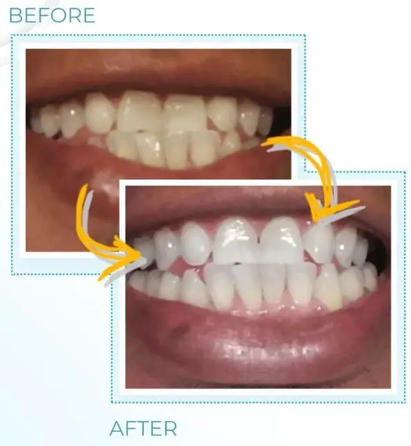 mobile white teeth whitening reviews