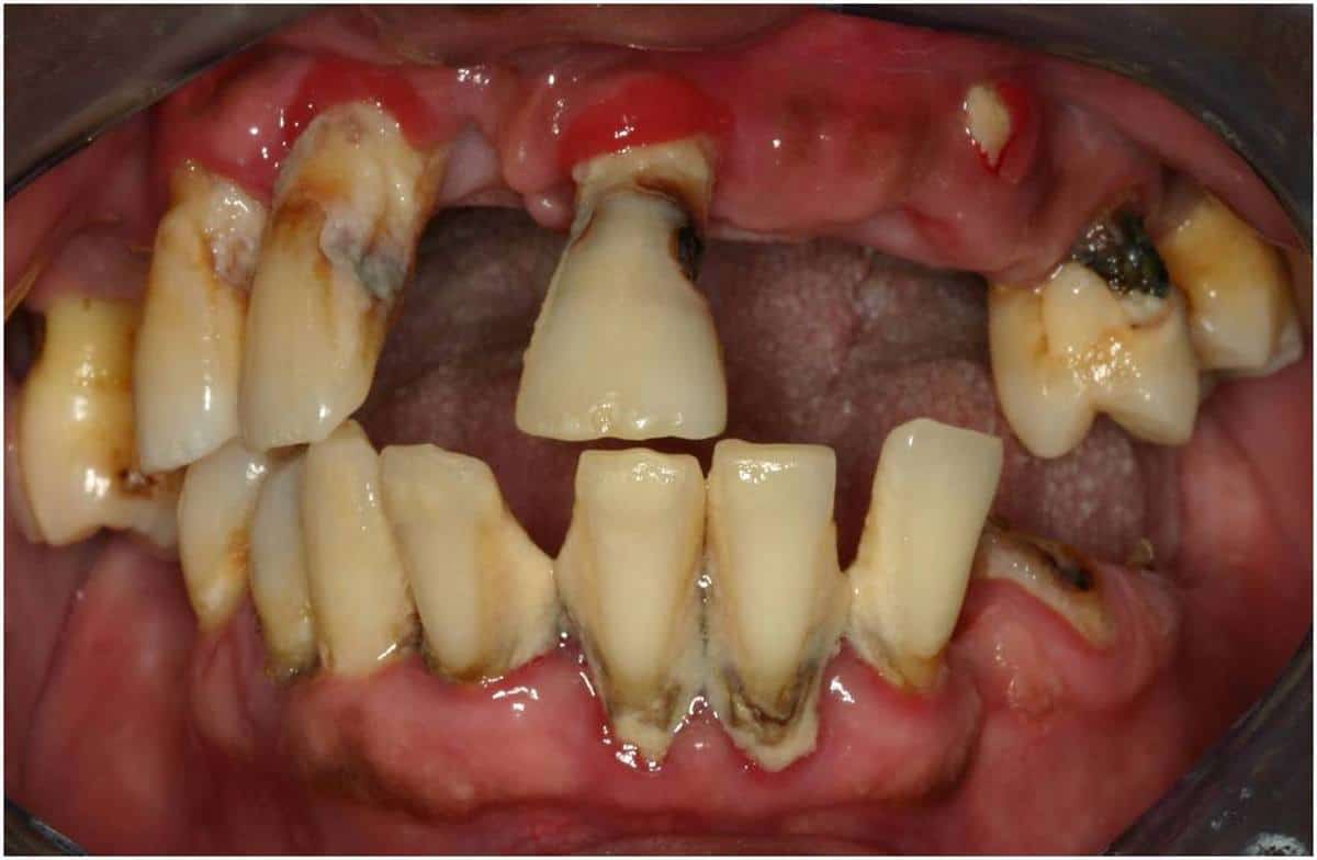genius labs teeth whitening review