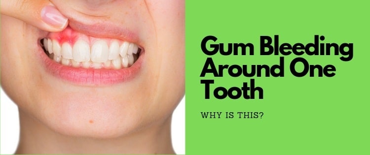 Gum Bleeding Around One Tooth When Flossing - Here's What To Do...