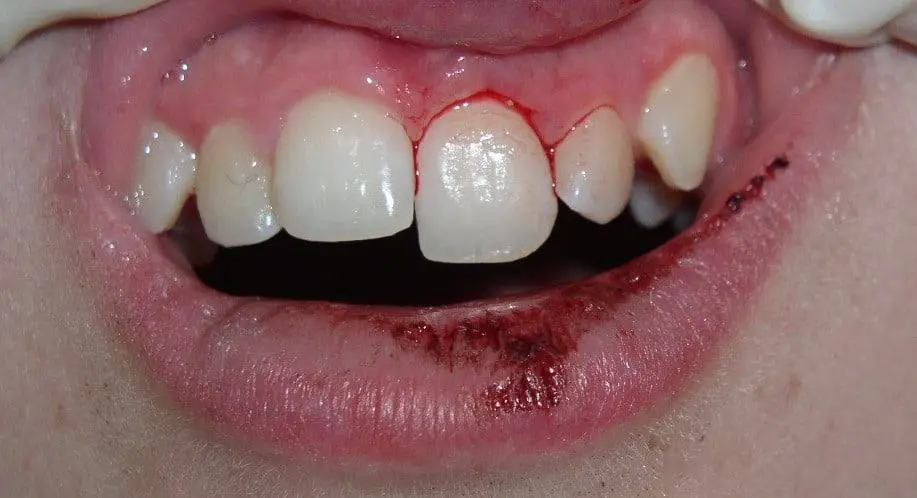 stop loose tooth falling out