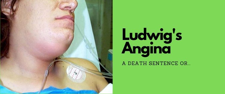 what-is-ludwigs-angina-dental-infection-gone-crazy-teethmastery