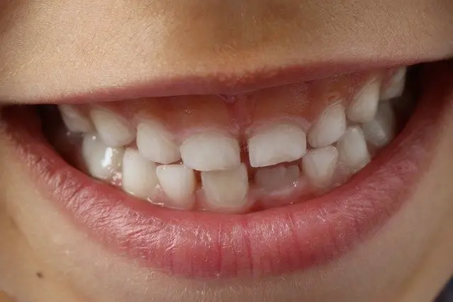 Can Wisdom Teeth Cause Jaw Pain?