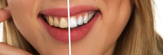 How Much Does Teeth Whitening Cost
